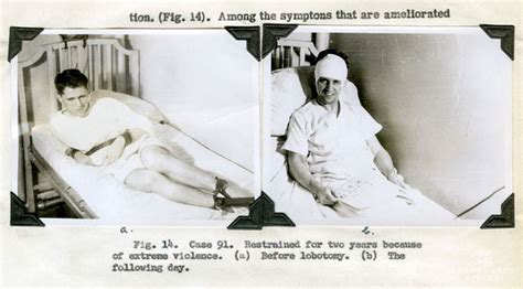 21 Disturbing Pictures of Lobotomy Before and After | Bored Panda