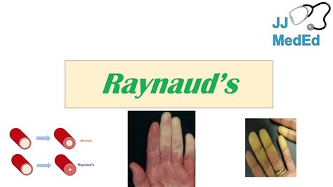 Which Statement Is Accurate Regarding Reynaud Disease? - Quotes Trendy