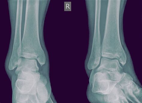 Medial Malleolus Fracture and Broken Ankle Treatment