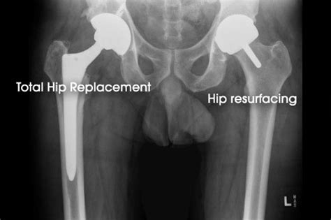 Hip Joint Resurfacing | Sydney Orthopaedic Trauma & Reconstructive Surgery