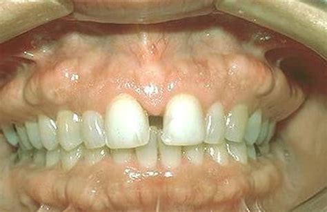 Exostosis - of Foot, Mouth, Ear, Definition, Pictures - HubPages