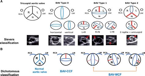 Frontiers | Bicuspid Aortic Valve: An Update in Morphology, Genetics ...