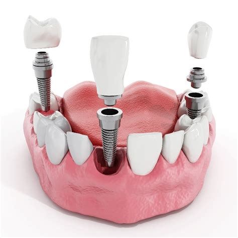 Are Dental Implants Painful? Here's What You Need to Know!