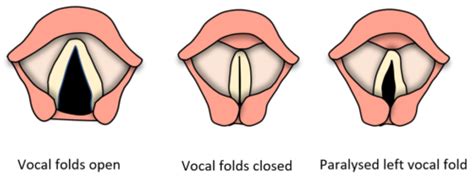 Vocal Fold Paralysis