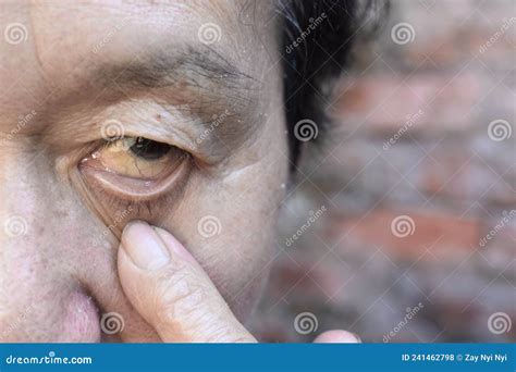 Pale Skin of Asian Man. Sign of Anemia. Pallor at Eyelid Stock Photo ...