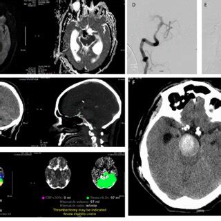 These cans were taken after VP shunt placement demonstrating extensive... | Download Scientific ...