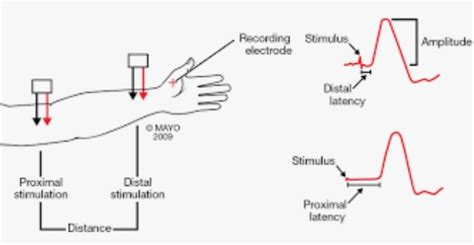 Nerve Conduction Studies - Hand - Orthobullets