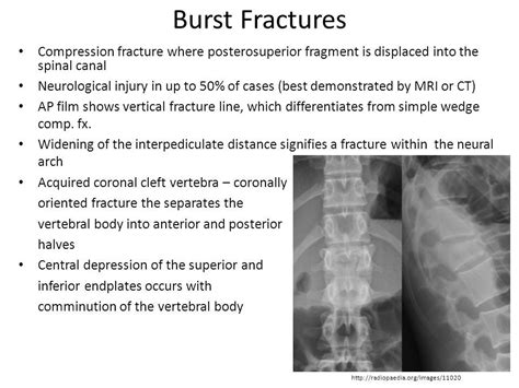 t12 burst fracture | Spinal canal, Car accident injuries, Fracture