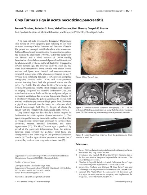 (PDF) Grey Turner's sign in acute necrotizing pancreatitis