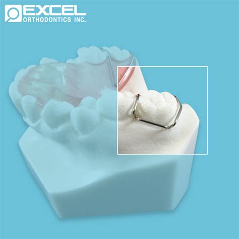 Clasp Options - Excel Orthodontics