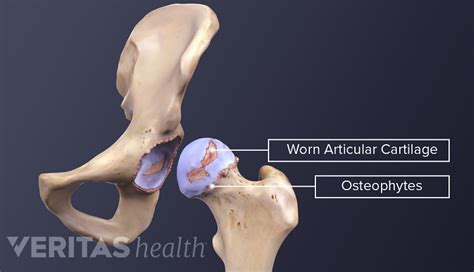 What Is Hip Osteoarthritis? | Arthritis-health