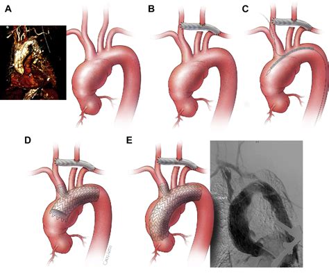 Figure 3 from Endovascular Treatment Options for the Aortic Arch. | Semantic Scholar