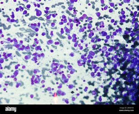 Microscopic image of Multiple Myeloma. Multiple Myeloma is type of ...