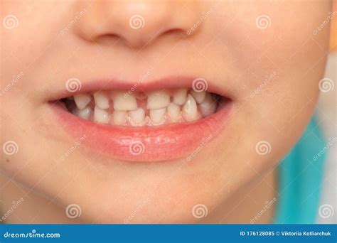Baby White Teeth Close-up, Smiling Little Boy in Full Mouth Stock Image ...
