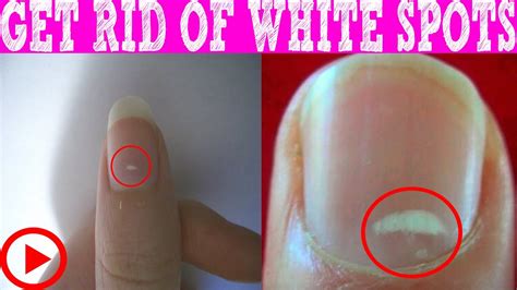 How to Get Rid of White Spots on Nails within 3 days | White Spots On Nails What It Really Means ...