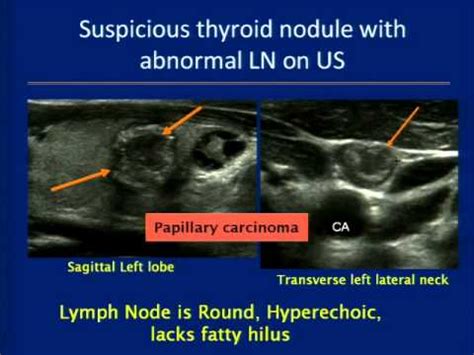 Thyroid Ultrasound Course - YouTube