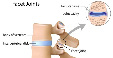 Facet Joint Arthritis: Everything You Need to Know - Patrick Senatus, M.D.