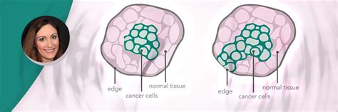 Lumpectomy versus Mastectomy? – Montclair Breast Center