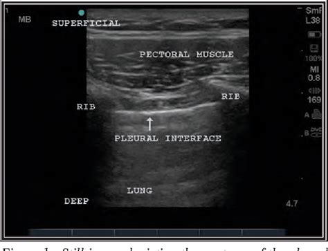 [PDF] Ultrasound detection of pneumothorax with minimally trained ...