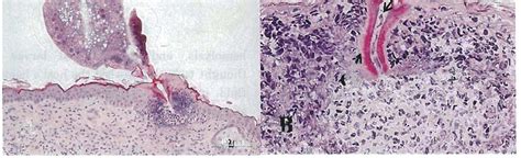 Histopathological findings of L. deliense-infested mouse skin at 24h ...