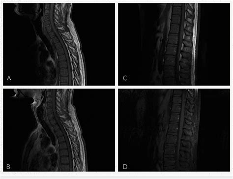 MRI cervical, thoracic, and lumbar spine with and without contrast A:... | Download Scientific ...