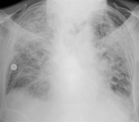 Acute Respiratory Distress Syndrome (ARDS): Phases & Treatment