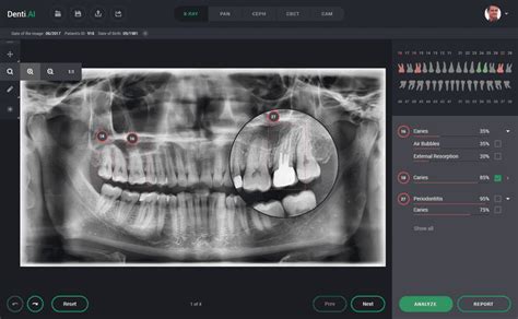 How AI 'assist' Dentists To Save Tooth?