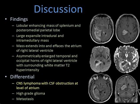 #lymphoma. | Brain anatomy, Mri brain, White matter