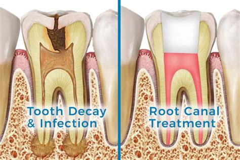 How Painful Is A Root Canal Reddit at Edward McCracken blog