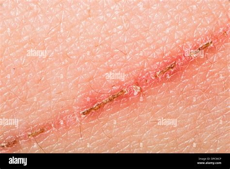 Texture of human skin and scratch. Extreme close up macro shot Stock Photo: 65432998 - Alamy