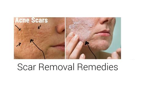 Home Remedies for Scar Removal | Top 10 Home Remedies