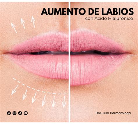 Aumento de Labios con Ácido Hialurónico - Lula Derma