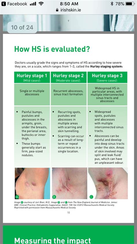 What you need to know about Hidradenitis Supprativa book #hs #hidradenitis #h… | Hidradenitis ...