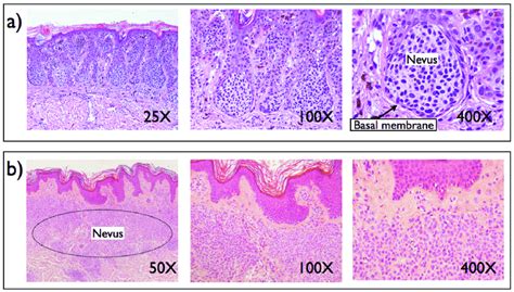 Congenital Melanocytic Nevus Histology