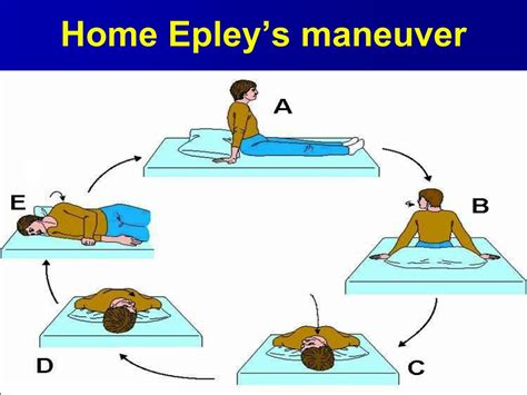 When To Stop Doing Epley Maneuver at Lisa Sweet blog