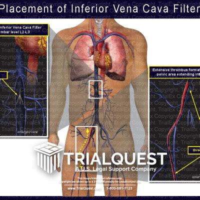 Placement of Inferior Vena Cava Filter - TrialExhibits Inc.