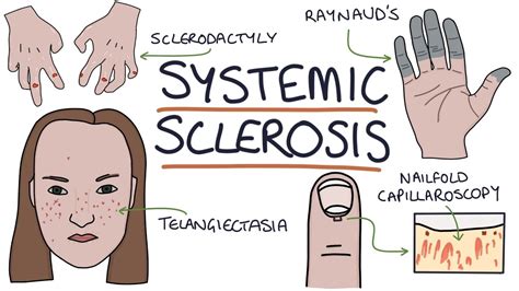 Systemic Scleroderma Hands