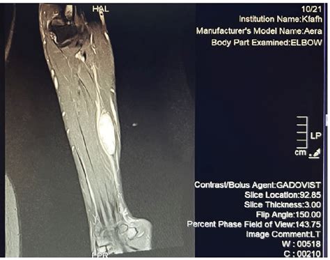 Showing superficial soft tissue swelling in the left mid forearm ...