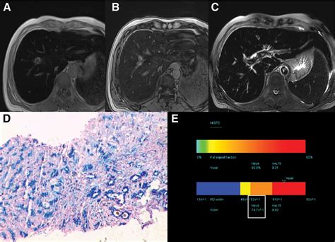 Magnetic resonance spectroscopy for quantification of liver... : Medicine