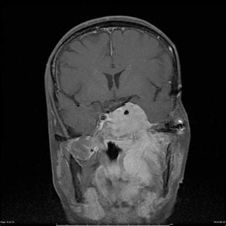 Skull base meningioma with infratemporal extension | Radiology Case | Radiopaedia.org