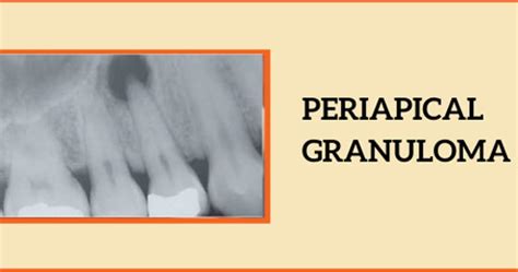 Dental Granuloma: Symptoms, Causes, Treatments