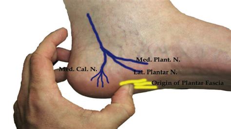 Baxter’s Nerve Entrapment - Peak Podiatry