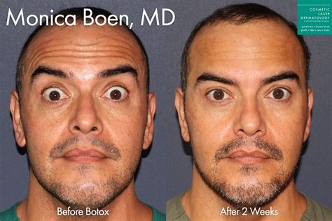 Most Common Side Effects of Botox - Cosmetic Laser Dermatology Skin ...