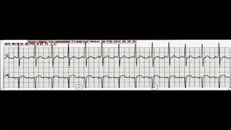 Intro to Cardiac Telemetry - The ECG Strip - YouTube