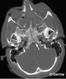 Longitudinal Clival Fracture: A Lethal Injury Survived | Barrow