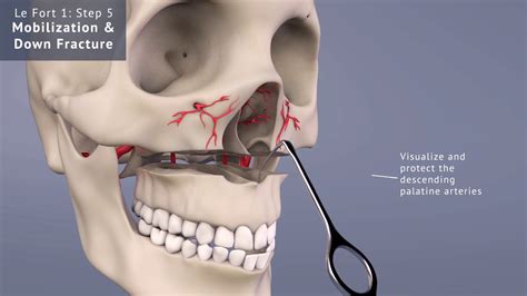 Le Fort 1: Down Fracture - YouTube