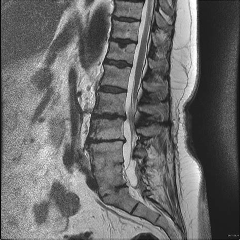 Arachnoiditis | Image | Radiopaedia.org