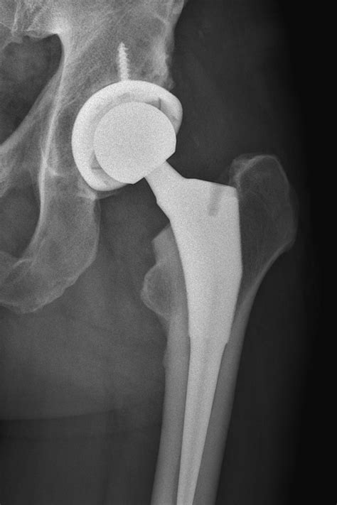 Normal hip replacement xray - statheroes