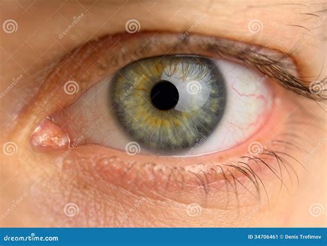 Tired Man Eye with Blood Vessels Stock Image - Image of light, facial ...