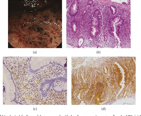 Figure 3 from Narrow-Band Imaging Colonoscopy to Assess Mucosal Angiogenesis in Ulcerative ...